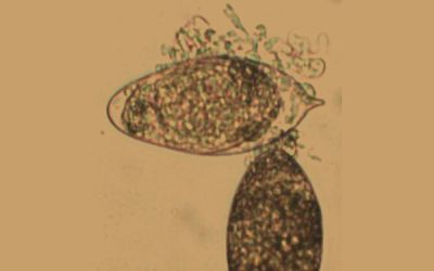 Schistosomiasis